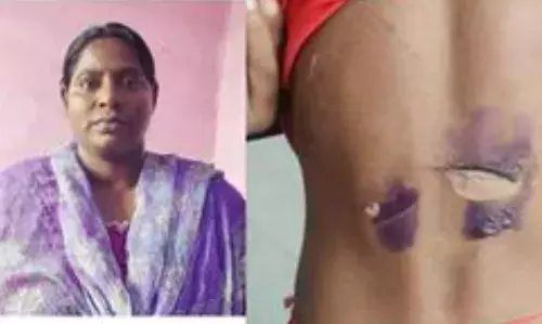 கணவரின் முதல் மனைவியின் மகன்களின் உடம்பில் சூடு வைத்த  சித்தி கைது