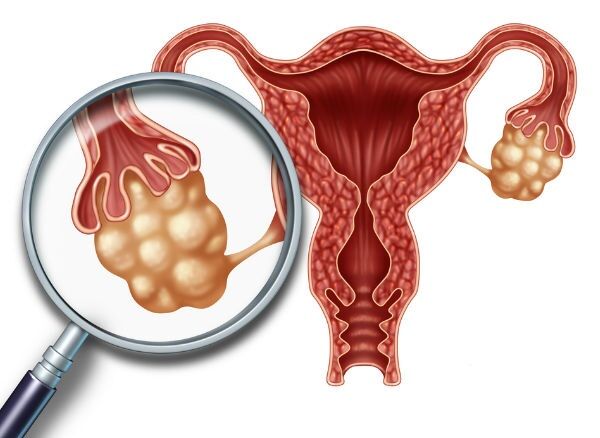 cyst-meaning-in-tamil-mostly-unaffected-by-ovarian-cysts-some-women