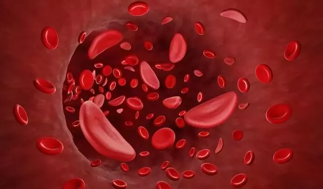 Sickle Cell Anemia in Tamil Sickle Cell Anemia in Tamil