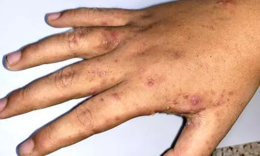 Scabies Meaning in Tamil Scabies Meaning in Tamil