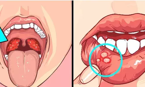 Mouth Cancer Symptoms in Tamil