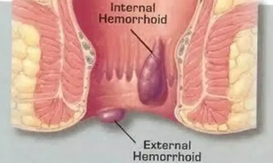 Piles Remedy in Tamil Piles Remedy in Tamil