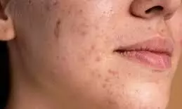 homeo treatment for psoriasis disease-சொரியாசிஸ் எனப்படும் செதில்படை நோய்க்கு ஹோமியோ சிகிச்சையில் தீர்வு homeo treatment for psoriasis disease-சொரியாசிஸ் எனப்படும் செதில்படை நோய்க்கு ஹோமியோ சிகிச்சையில் தீர்வு