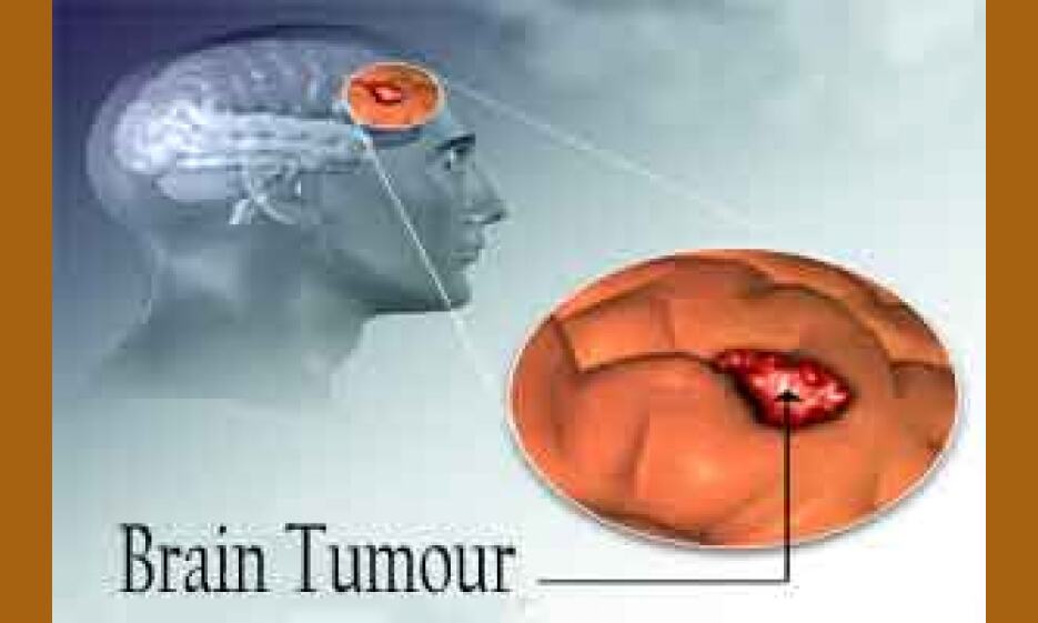 brain-tumor-in-tamil