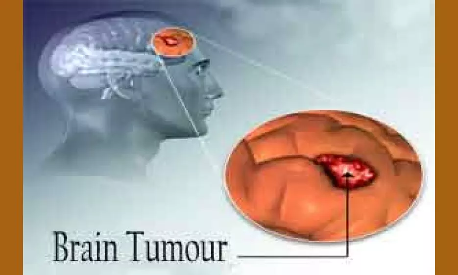 Brain Tumor in Tamil Brain Tumor in Tamil