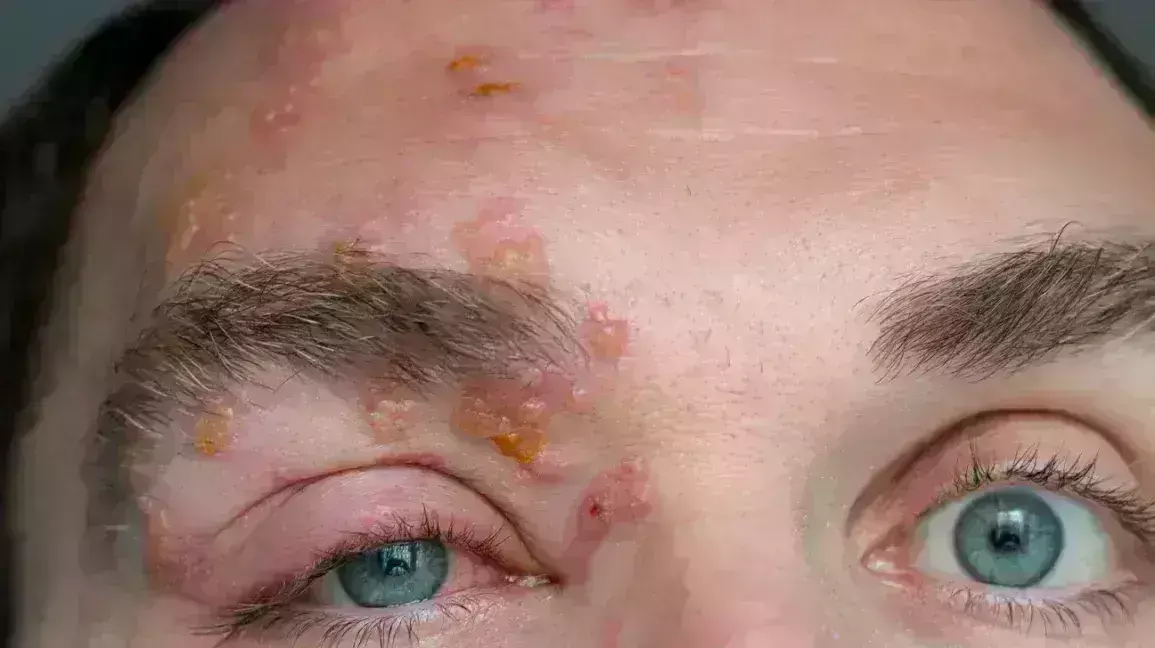 akki disease in tamil தோல்களில் ஏற்படும் தொற்றுநோய் அக்கி: சிகிச்சை முறைகள் என்னென்ன?.... akki disease in tamil தோல்களில் ஏற்படும் தொற்றுநோய் அக்கி: சிகிச்சை முறைகள் என்னென்ன?....