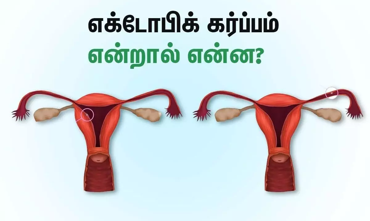 Ectopic Pregnancy in Tamil-கருப்பைக்கு வெளியே கர்ப்பம் தரித்தால் ஆபத்தானதா? தெரிஞ்சுக்கங்க..! Ectopic Pregnancy in Tamil-கருப்பைக்கு வெளியே கர்ப்பம் தரித்தால் ஆபத்தானதா? தெரிஞ்சுக்கங்க..!