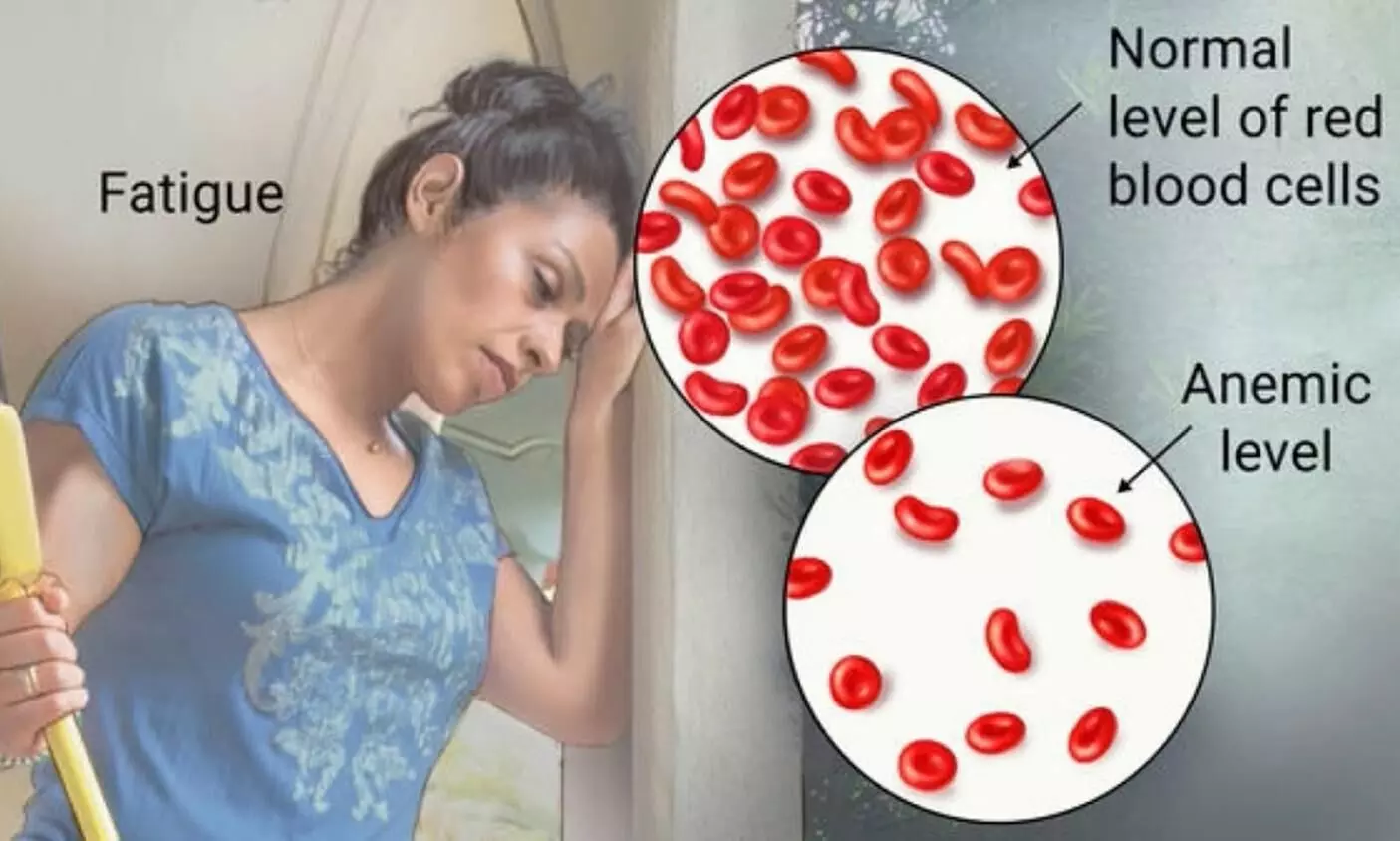 Anaemia meaning in Tamil-இரத்த சோகை வந்தால் என்ன செய்யலாம்? தெரிஞ்சுக்கங்க..! Anaemia meaning in Tamil-இரத்த சோகை வந்தால் என்ன செய்யலாம்? தெரிஞ்சுக்கங்க..!