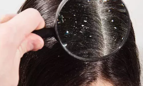 Dandruff Home Remedies in Tamil-பொடுகுத் தொல்லைக்கு எளிய வீட்டு வைத்தியம்..! Dandruff Home Remedies in Tamil-பொடுகுத் தொல்லைக்கு எளிய வீட்டு வைத்தியம்..!