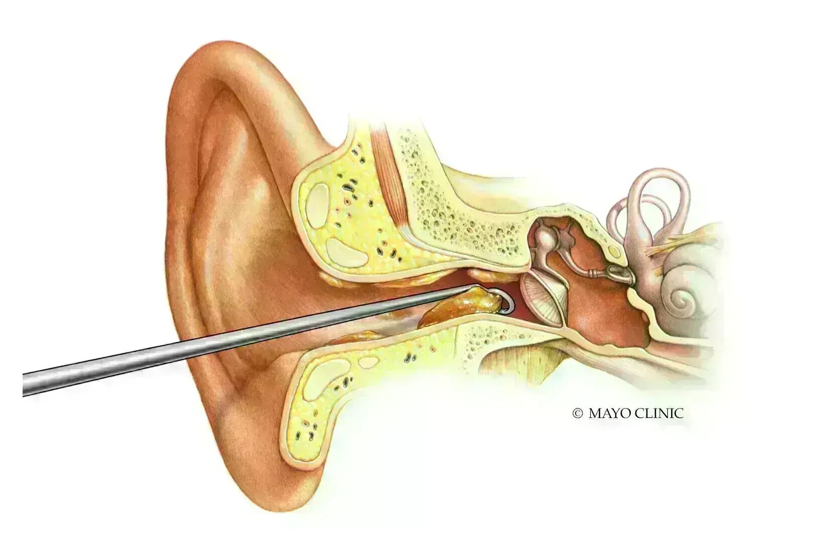 earwax-buildup-meaning-in-tamil