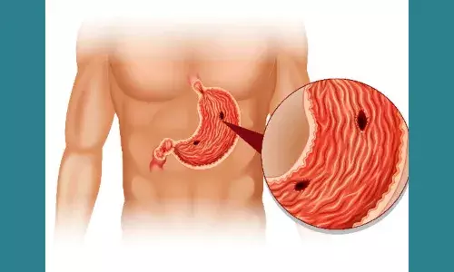 Stomach Cancer Symptoms In Tamil  இரைப்பை புற்றுநோய் ஏற்பட  காரணங்கள் என்னென்ன?...படிங்க.... Stomach Cancer Symptoms In Tamil  இரைப்பை புற்றுநோய் ஏற்பட  காரணங்கள் என்னென்ன?...படிங்க....
