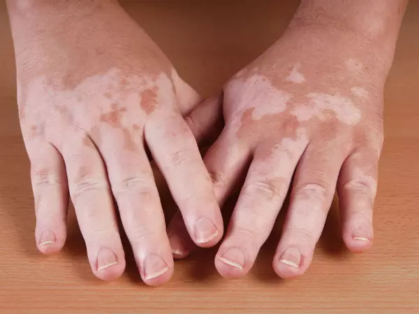 Vitiligo Treatment in Tamil Vitiligo Treatment in Tamil