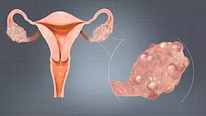 PCOS என்றால் என்ன? இதனால் பெண்கள் சந்திக்க கூடிய பிரச்சனைகள் என்ன? PCOS என்றால் என்ன? இதனால் பெண்கள் சந்திக்க கூடிய பிரச்சனைகள் என்ன?