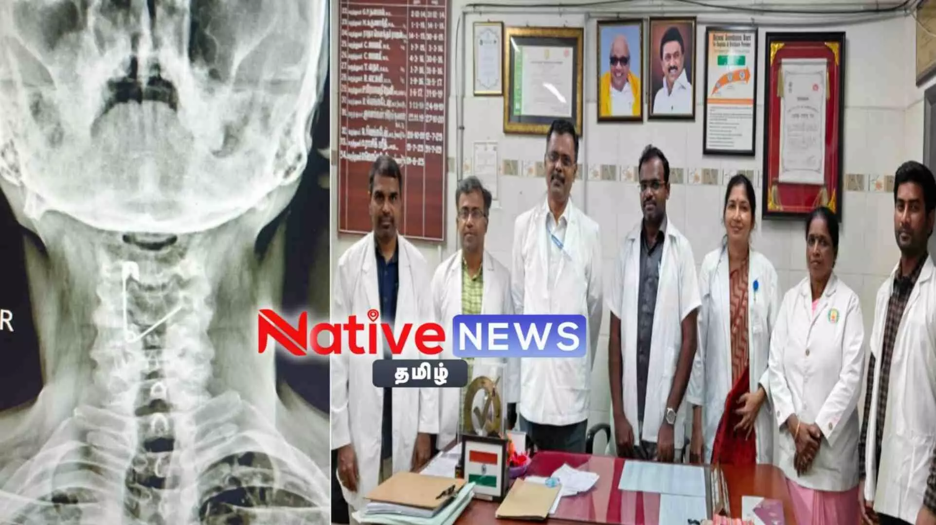 ஈரோடு அரசு தலைமை மருத்துவமனையில் தொழிலாளியின் தொண்டையில் சிக்கிய சேப்டி பின் அகற்றம்! ஈரோடு அரசு தலைமை மருத்துவமனையில் தொழிலாளியின் தொண்டையில் சிக்கிய சேப்டி பின் அகற்றம்!