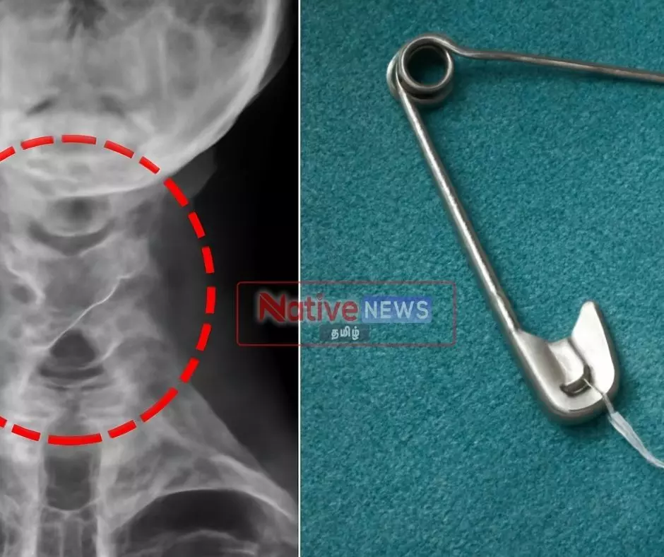 தொண்டையில் சிக்கிய பின்னூசி - பின்னூசியால் உயிருக்கு போராடிய நபர்! தொண்டையில் சிக்கிய பின்னூசி - பின்னூசியால் உயிருக்கு போராடிய நபர்!